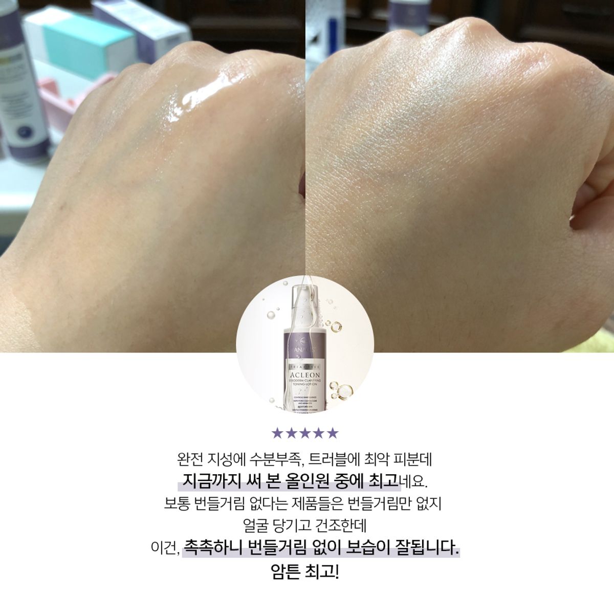 아클레온(ACLEON) 아나시스 민감성 수부지 여드름 히알루론산 에센스 토너 200ml