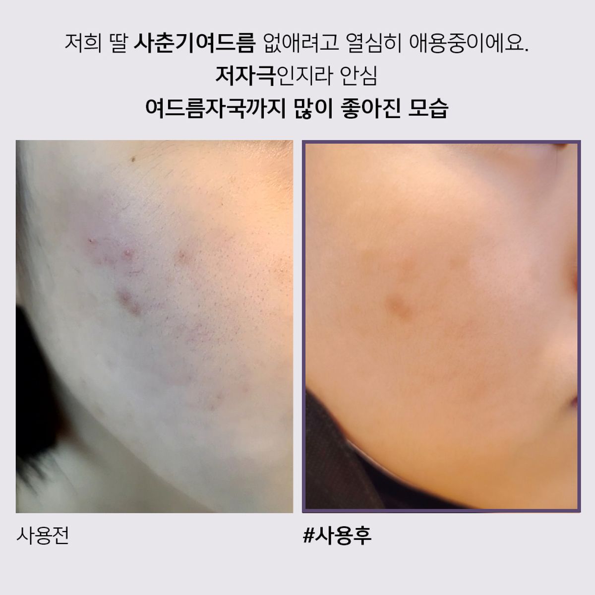 아클레온(ACLEON) 아나시스 아클레온 여드름  트러블 스팟 30ml