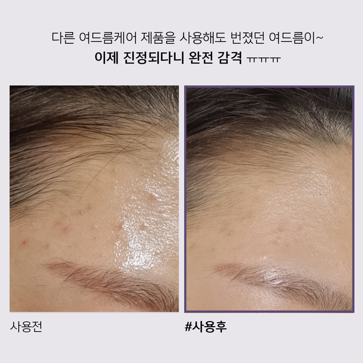아클레온(ACLEON) 아나시스 아클레온 여드름  트러블 스팟 30ml
