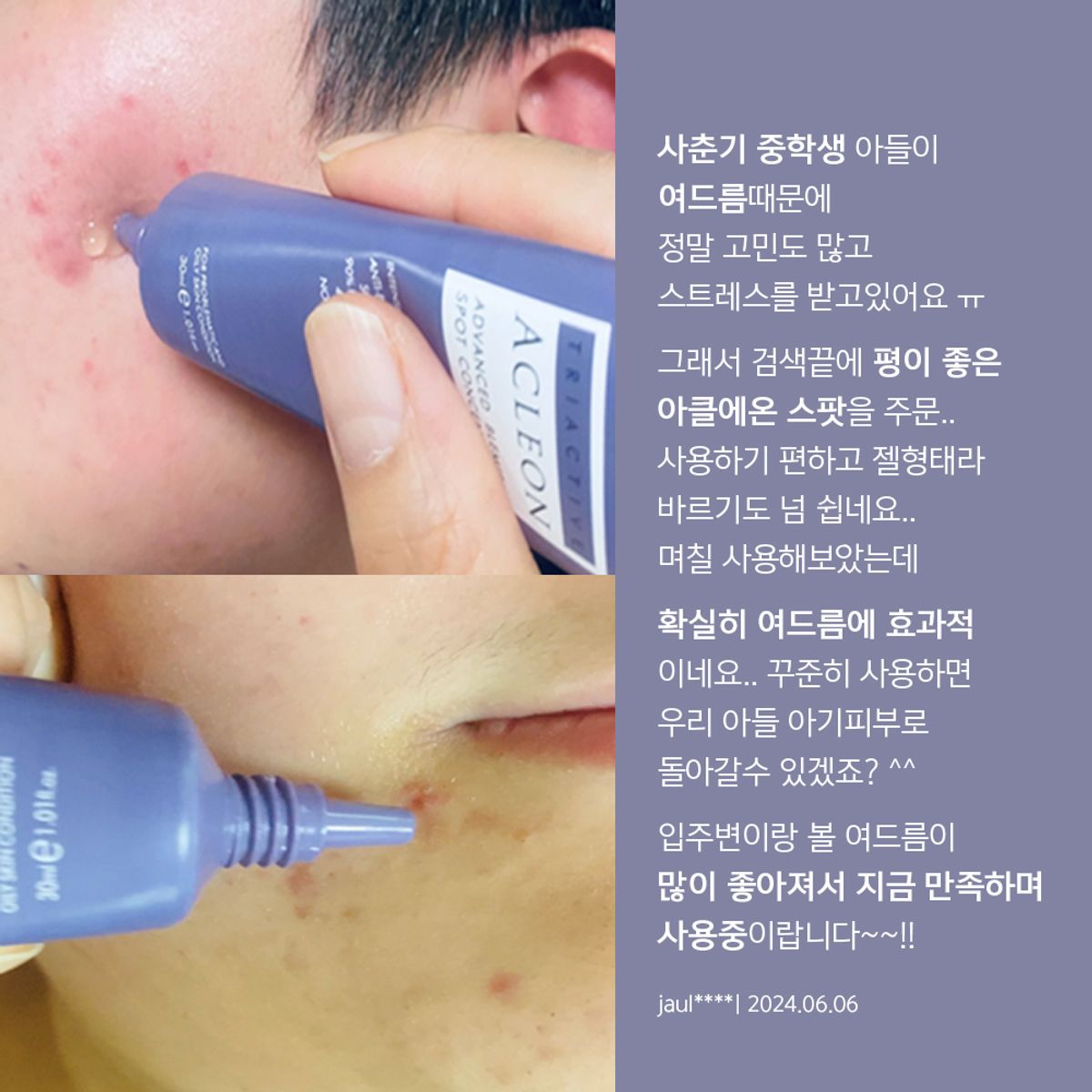 아클레온(ACLEON) 아나시스 아클레온 여드름  트러블 스팟 30ml