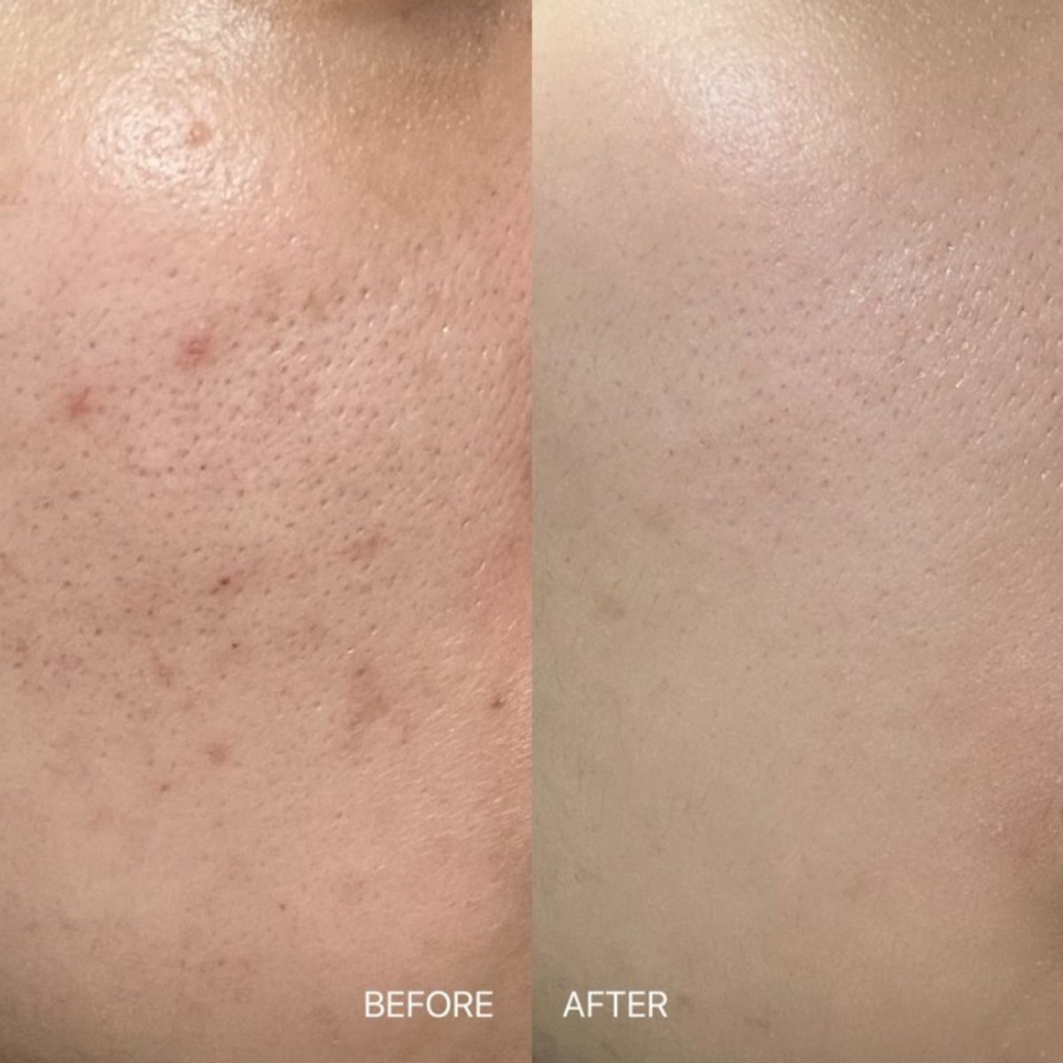 아클레온(ACLEON) 아나시스 여드름 클렌징 젤 200ml 모공 앰플 15ml 2종