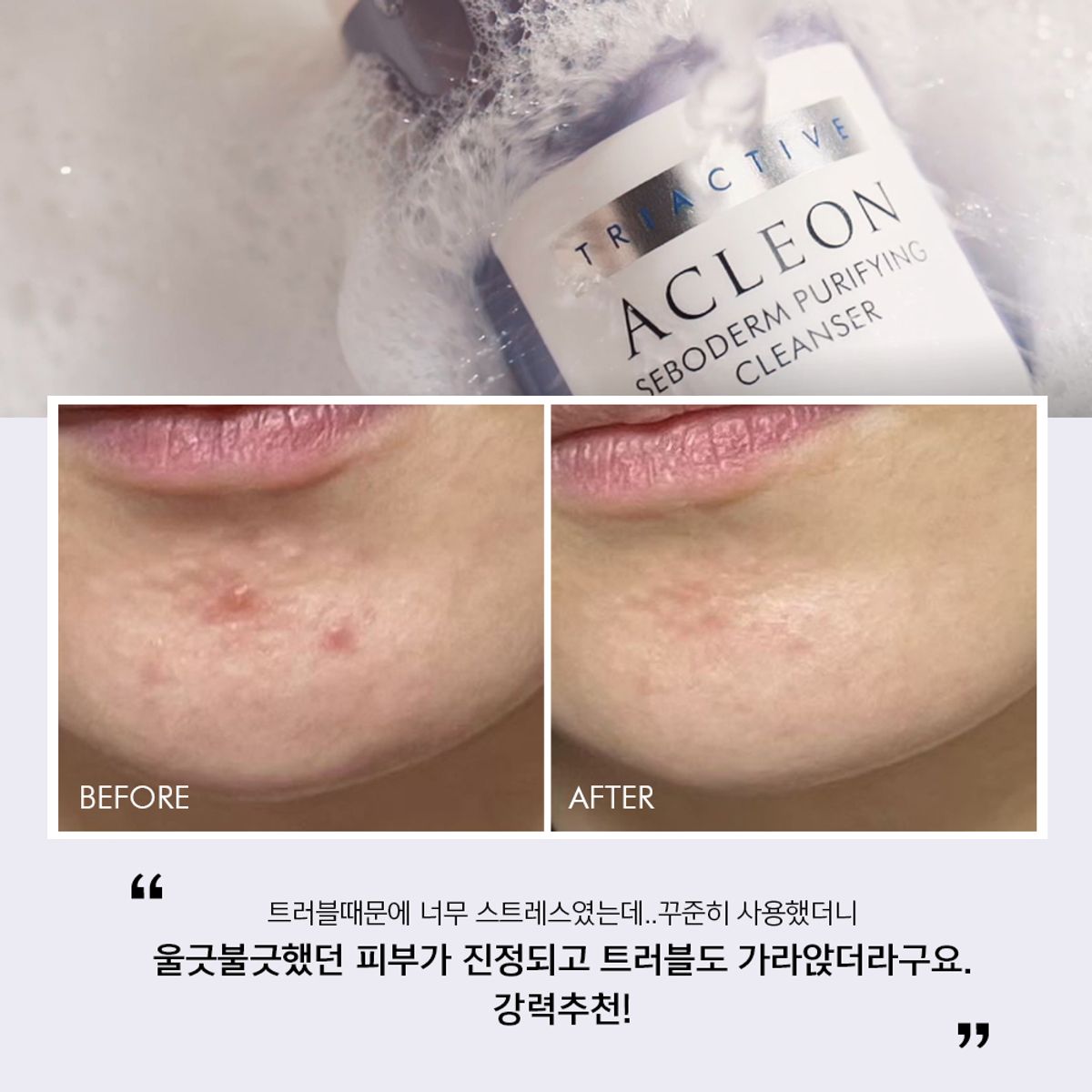 아클레온(ACLEON) 아나시스 청소년 여드름 화장품 약알칼리성클렌징폼 모공앰플 올인원 스킨로션 3종