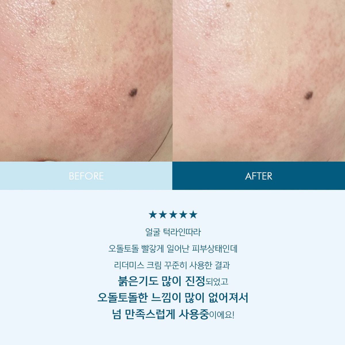 리더미스(LITHEMIS) 아나시스 멍크림 15ml 피부과 재생크림 50ml  2종세트