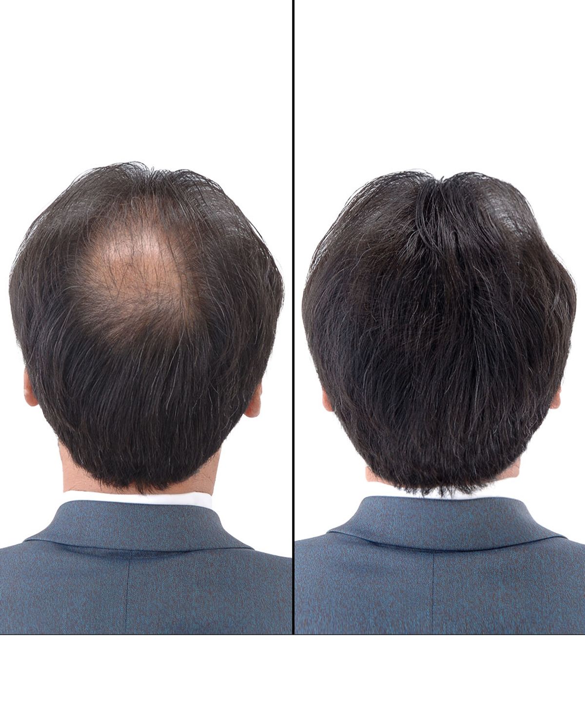 슈퍼밀리언헤어(SUPER MILLION HAIR) 흑채 25g 1개 + 전용미스트 165ml 1개
