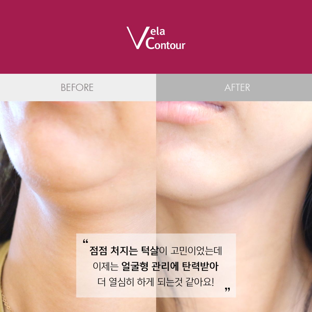 벨라컨투어(VELACONTOUR) 목주름 턱선 심부볼 탄력 리프팅 앰플 30ml 13종임상완료