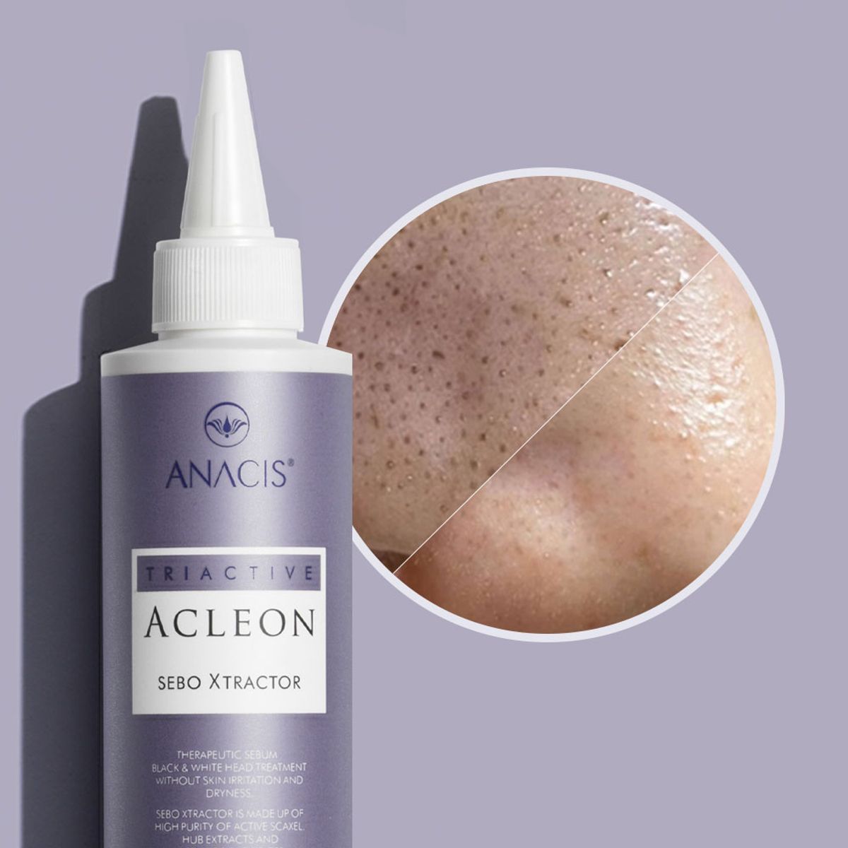 아클레온(ACLEON) 아나시스 블랙헤드제거 피지연화제 지루성두피 스케일링 1000ml + 모공앰플 15ml