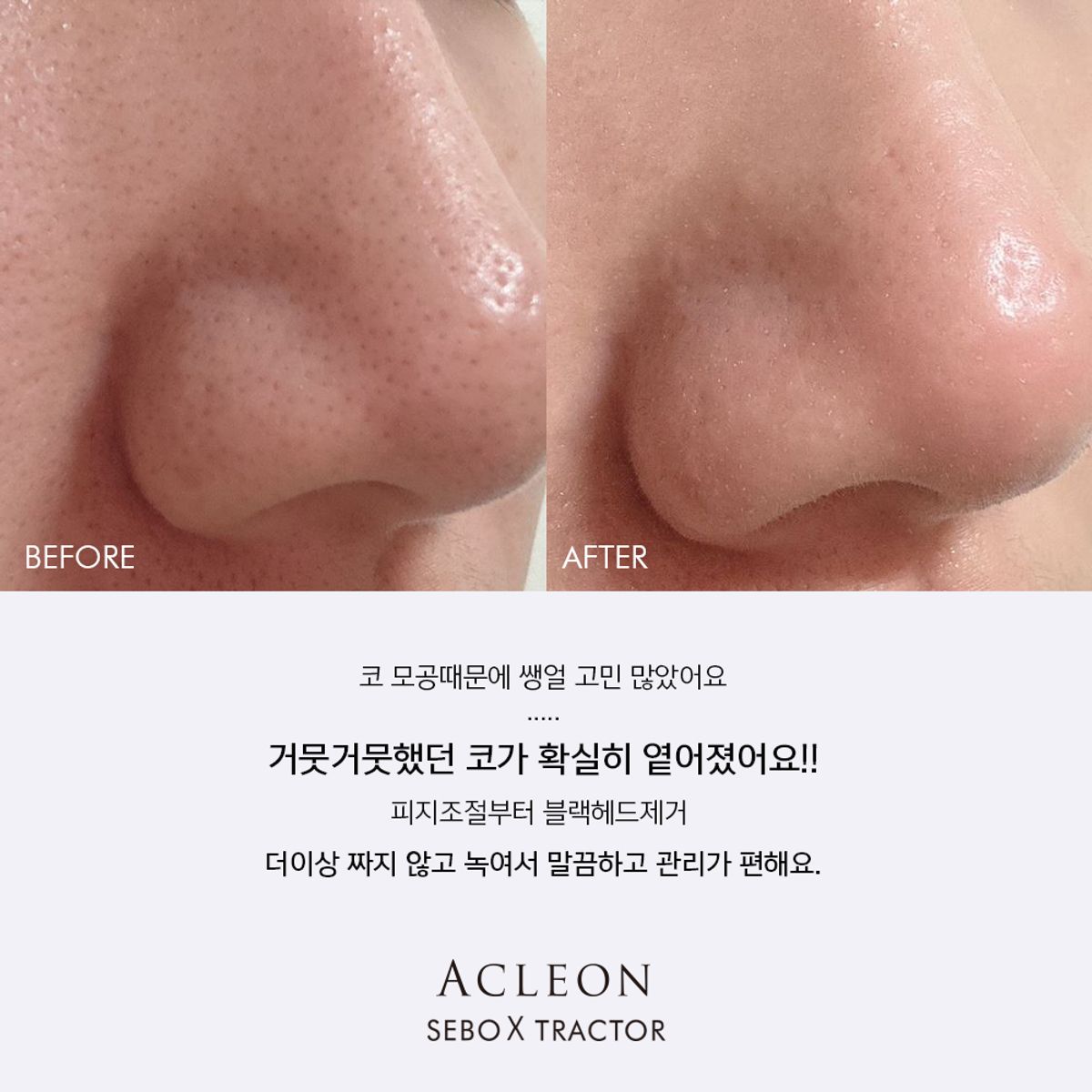 아클레온(ACLEON) 아나시스 블랙헤드제거 피지연화제 지루성두피 스케일링 1000ml + 모공앰플 15ml