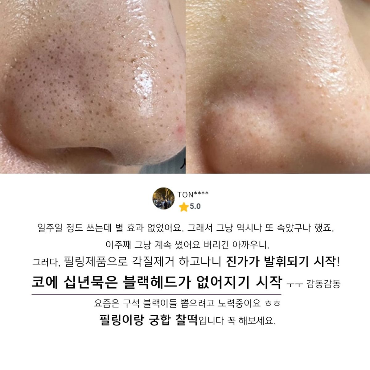 아클레온(ACLEON) 아나시스 블랙헤드제거 피지연화제 지루성두피 스케일링 1000ml + 모공앰플 15ml