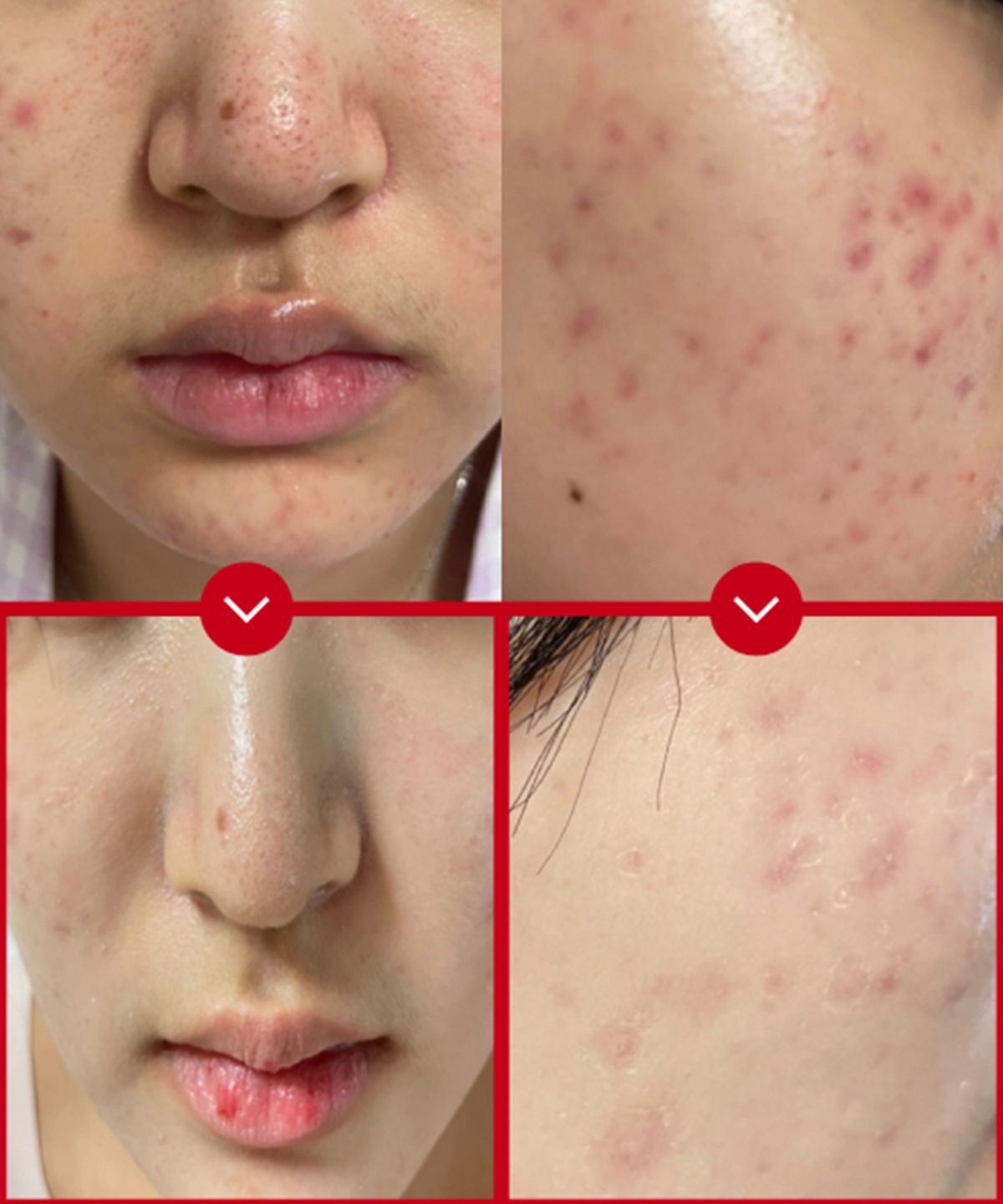 벤더마(VENDERMA) 레드카밍 시카 엑소좀 2주 집중케어 프로그램 세트